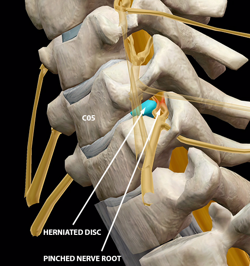 Cervical Radiculopathy Nerve